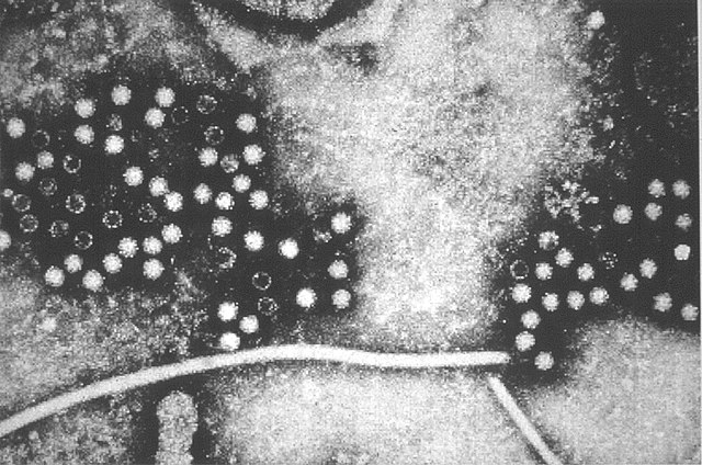 Hepatitis E: 20 millones de infecciones al año