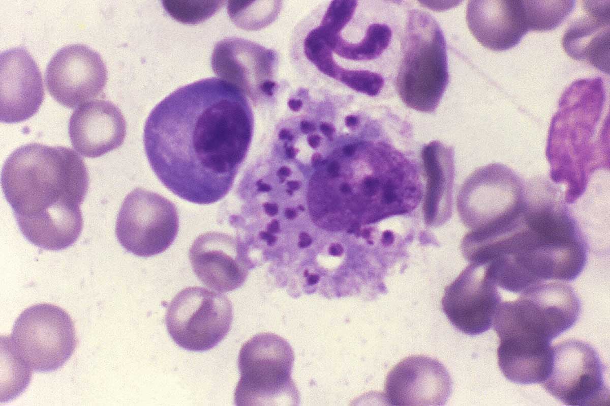 Avances contra la leishmaniasis